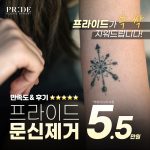 프라이드 문신제거