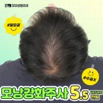 모발을 튼튼하게 만드는 모낭강화주사 탈모치료